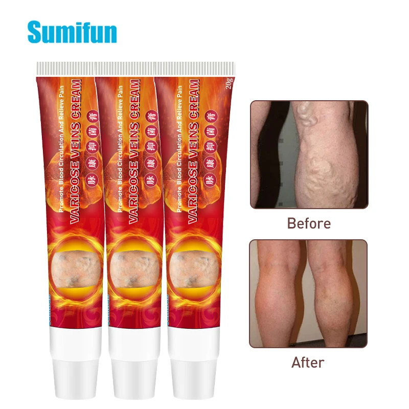 

3pcs Varicose Veins Cream Ointment For Varicose Veins Of Legs Varicosity Angiitis Remedy Treatment Phlebitis Pain Relief D3175