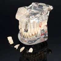 dental teeth model implant disease with restoration bridge tooth dentist for medical science dental disease teaching study tool