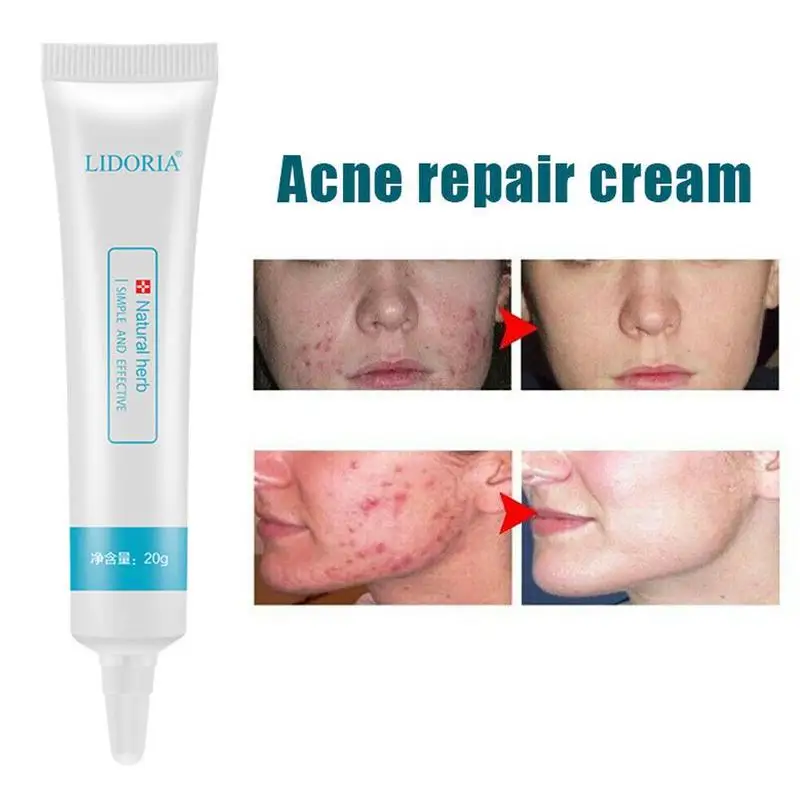 Травяной шрамовый знак удаление кожи тела кремовый дефект уход восстановление