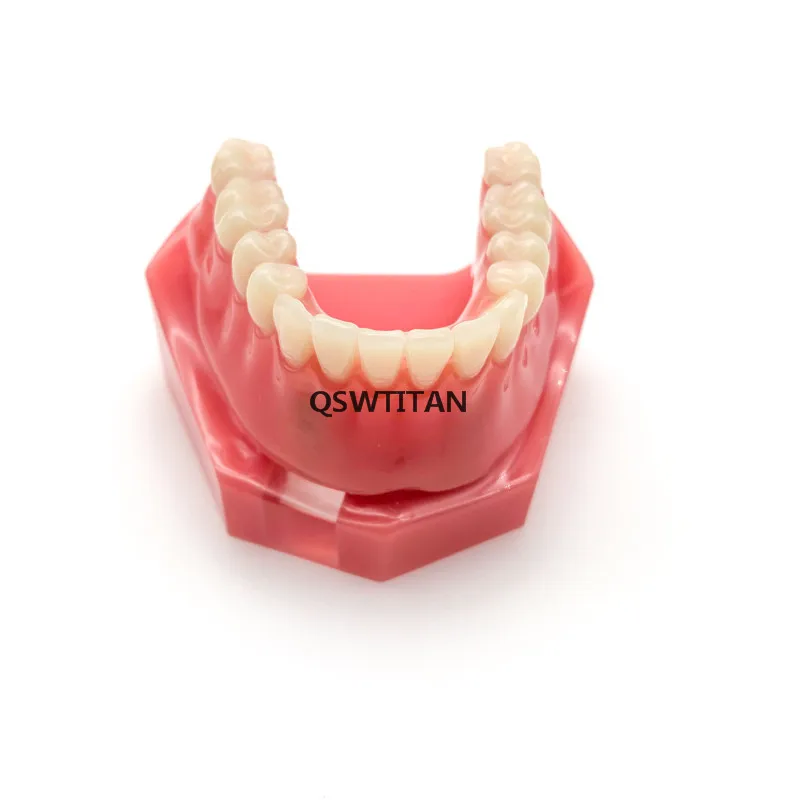 Стоматологическая уступает имплантат Overdenture 6007 модель зубов 2 импланты с