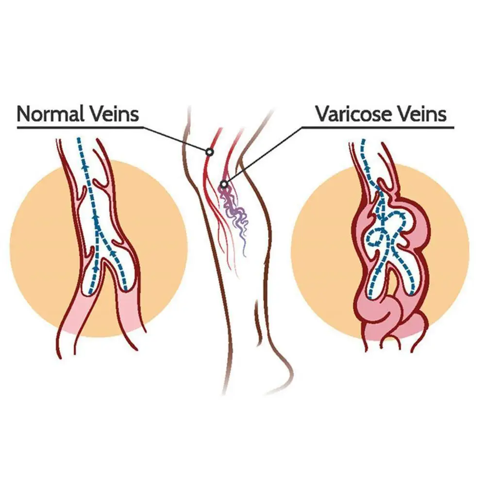 

Varicose Veins Cream Of Varicose Veins Medical Spider Treatment Veins Varicose Medicine 20g Veins Herbal Chinese Ointment F0S5