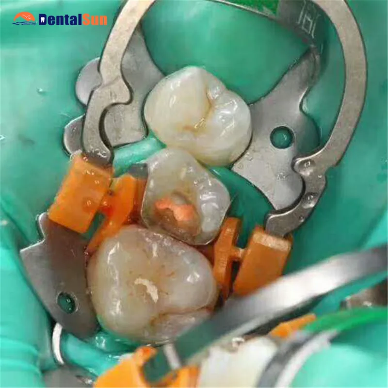 Стоматологическая секционная матричная система