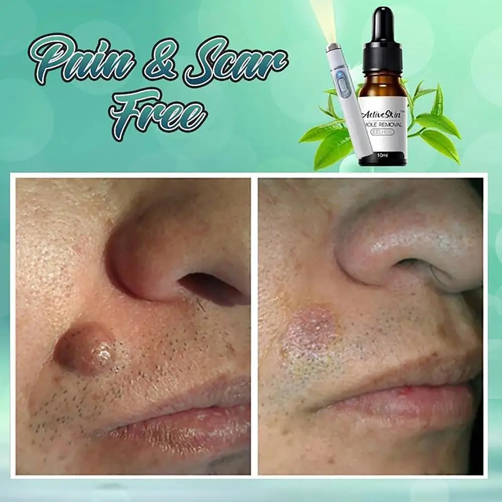 

Faster And Effective Anti-Tags Home Aid Kit Painless Removal Skin Fast Removal Serum Fast Genital Remover Wart Tag Mole E5Z7