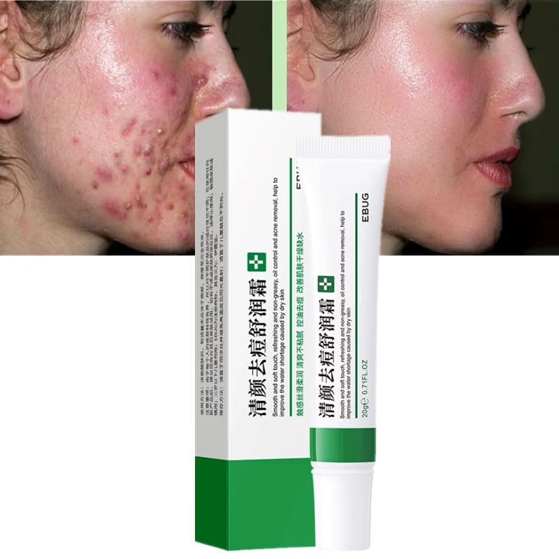 

Effective Acne Removal Cream Acne Treatment Fade Acne Spots Oil Control Shrink Pores Whitening Moisturizing Acne Cream Skin Care