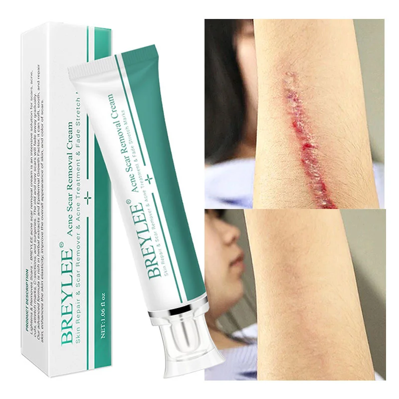 

BREYLEE Acne Scar Removal Cream Face Pimples Spots Stretch Marks Cream Surgical Scar Treatment Moisturizer Whitening Skin Care