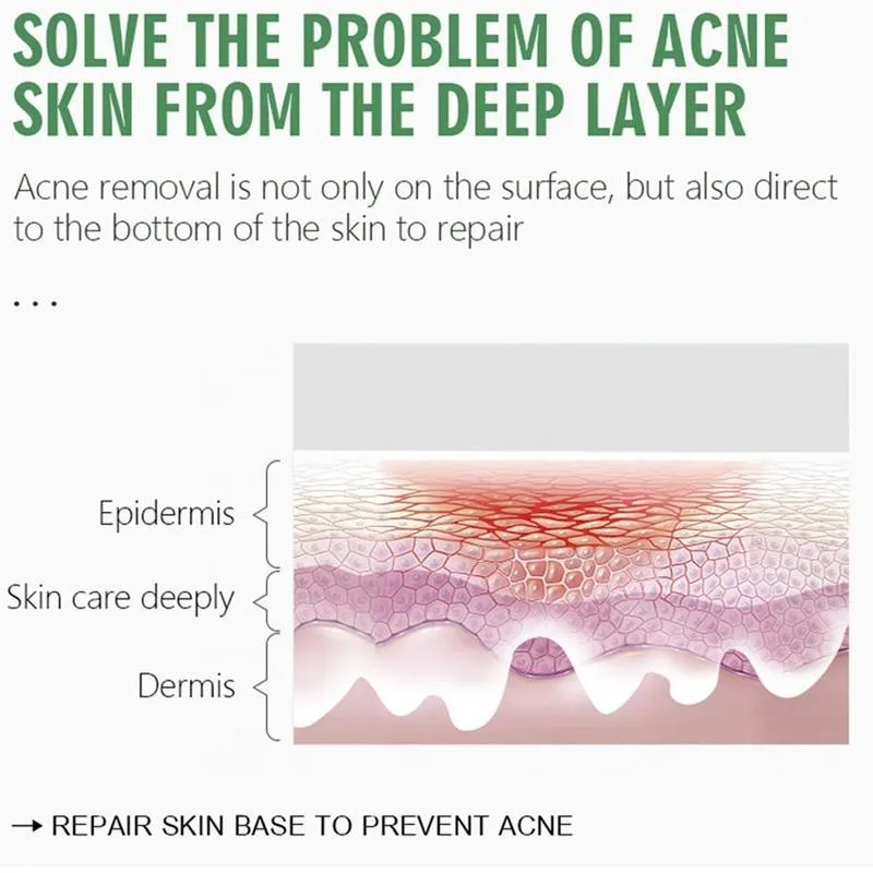 

30ml Tea Tree Acne Essence Serum Natural Repair Whitening Moisturizing Oil Control Improve Sensitive Skin Care Acne Essence