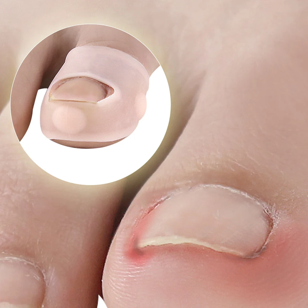 

5 Pairs Silicone Elastic Ingrown Toenail Corrector Straightening Foot Care