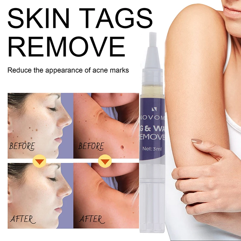 

Skin Tag Remover Against Mole & Genital Wart fast Removal Anti Foot Corn Treatment Anti Wart Bacteriostatic Liquid