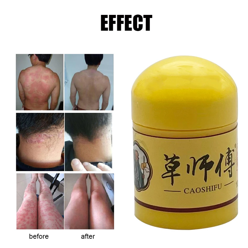 10Pcs Chinese Herbal Antibacterial Ointment Psoriasis Cream Anti-itch Dermatitis Eczematoid Eczema Treatment Medical Plaster - купить по