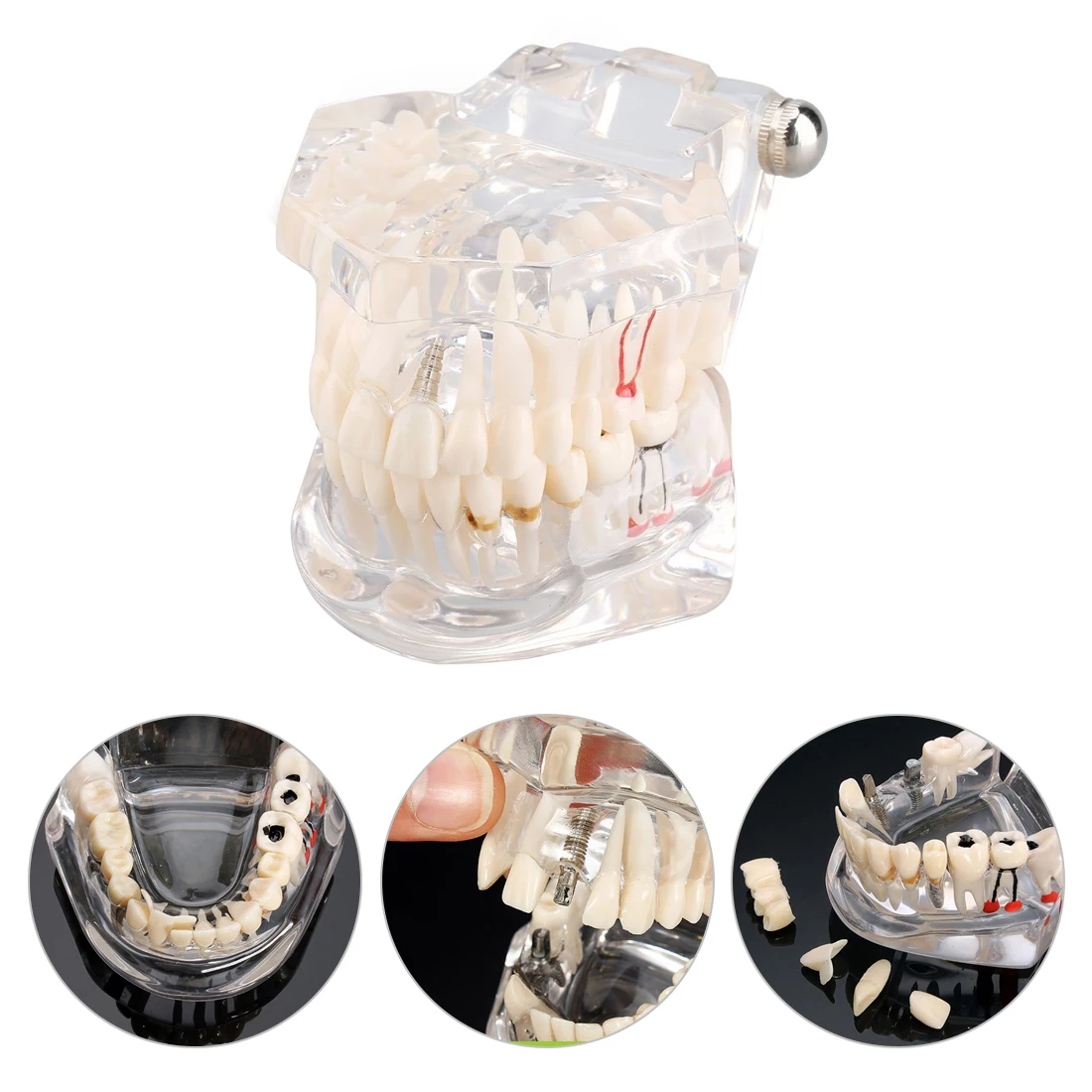 

high Teaching Study Tool For Medical Science Dental Disease Dental Implant Disease Teeth Model With Restoration Bridge Tooth