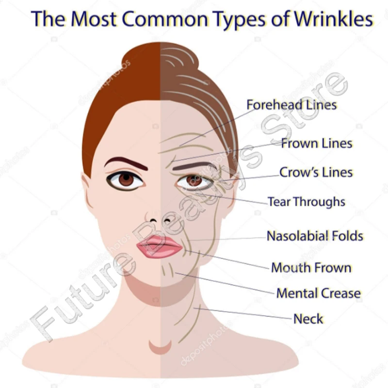 

100u boto x injection boto x filling to remove wrinkles hyaluronic acid pen