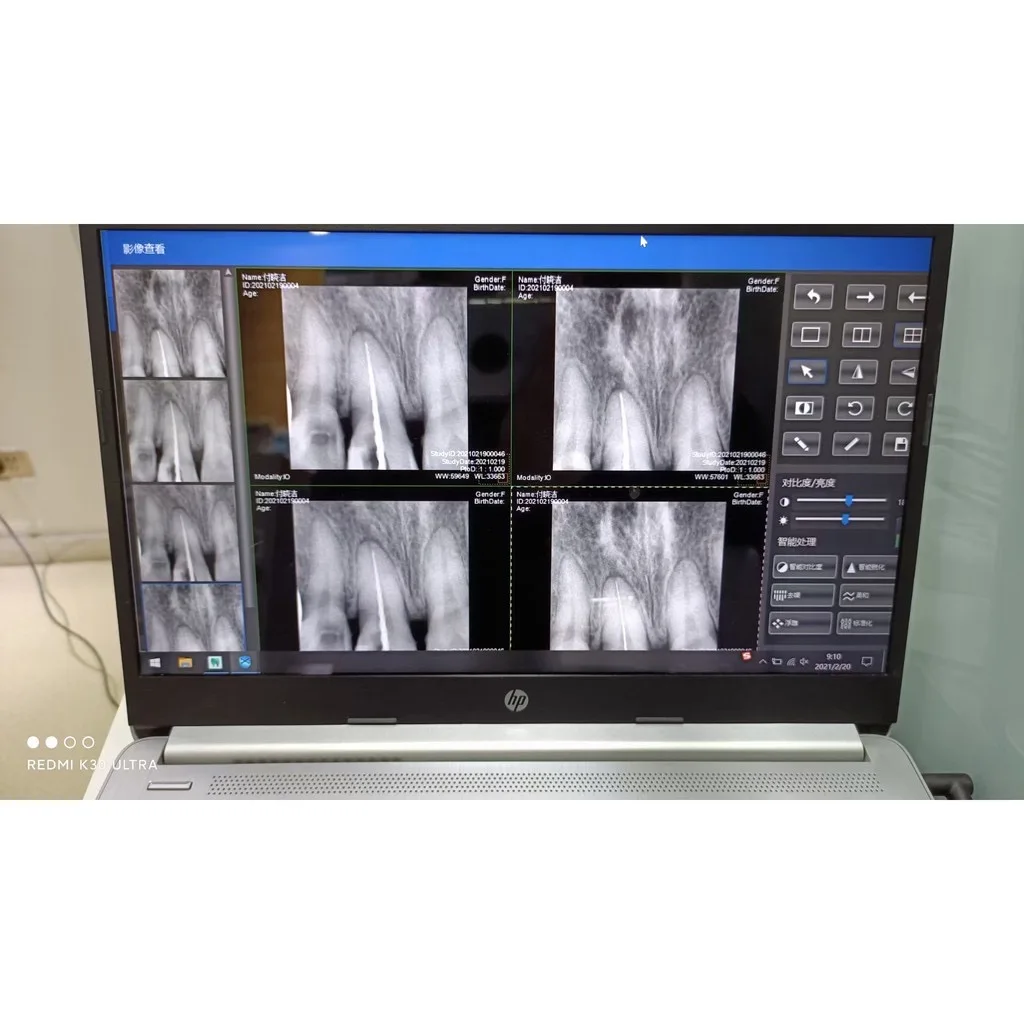Стоматологический рентгеновский аппарат высокочастотный цифровой портативный