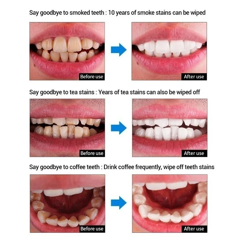 Набор для отбеливания зубов очищение быстрое удаление пятен уход за полостью рта