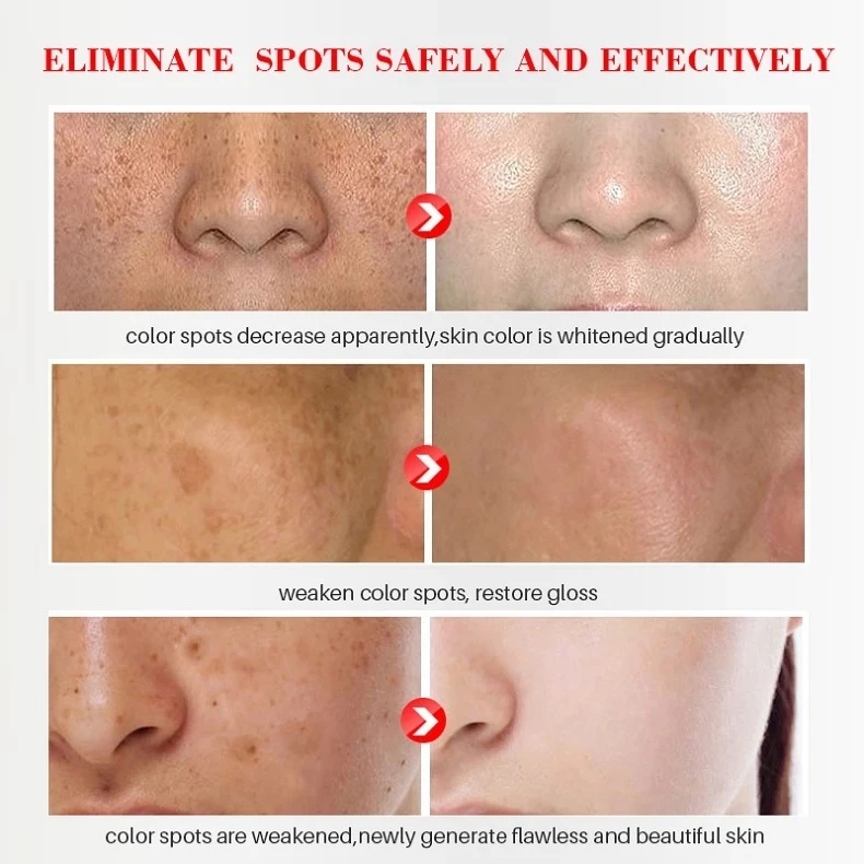 Effective Whitening Freckle Cream Remove Melasma Acne Spot Pigment Melanin Dark Spots Pigmentation Moisturizing Gel Skin Care | Красота и
