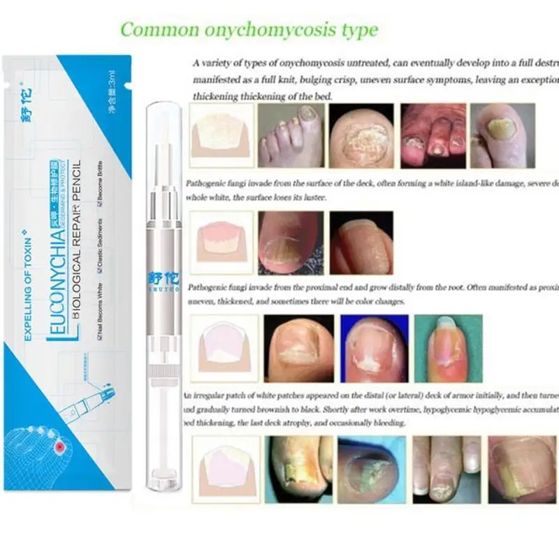 Противогрибковые ручки для лечения Ногтей Onychomycosis Paronychia инфекция травяной носок ногти лечение здоровья Красота аксессуары