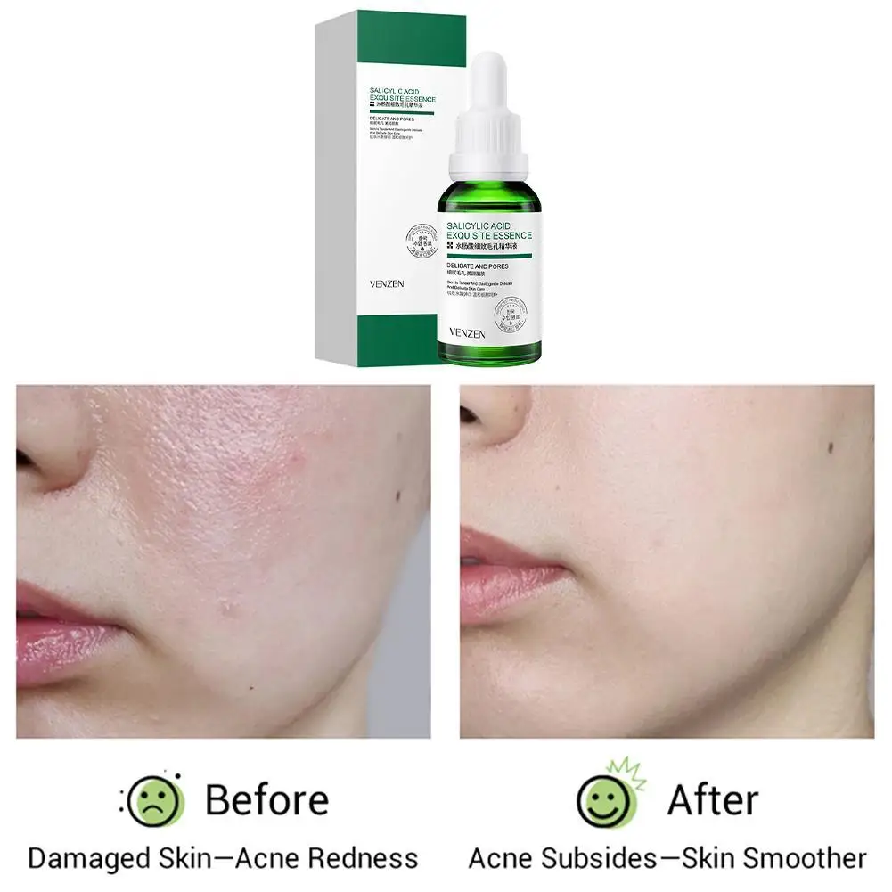 30ml Salicylic Acid Acne Treatment Serum Oil Control Shrink Pores Face Essence Hyaluronic Acid Moisturizing Brighten Skin Toner