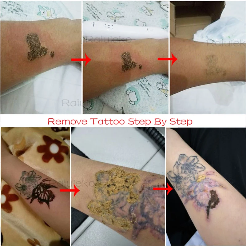 3 цвета Лазерная плазменная ручка новейшая технология удаление моль темное пятно