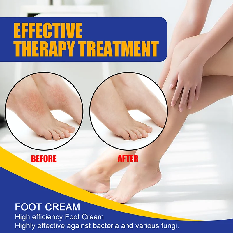 

Beriberi Cream Athletes Foot Skin Treatment Anti Fungal Fungus Rash Jock Itch