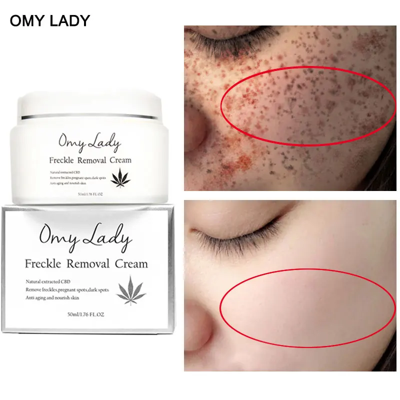 OMY LADY для отбеливания веснушек крем удаления пятен мощное средство лица против