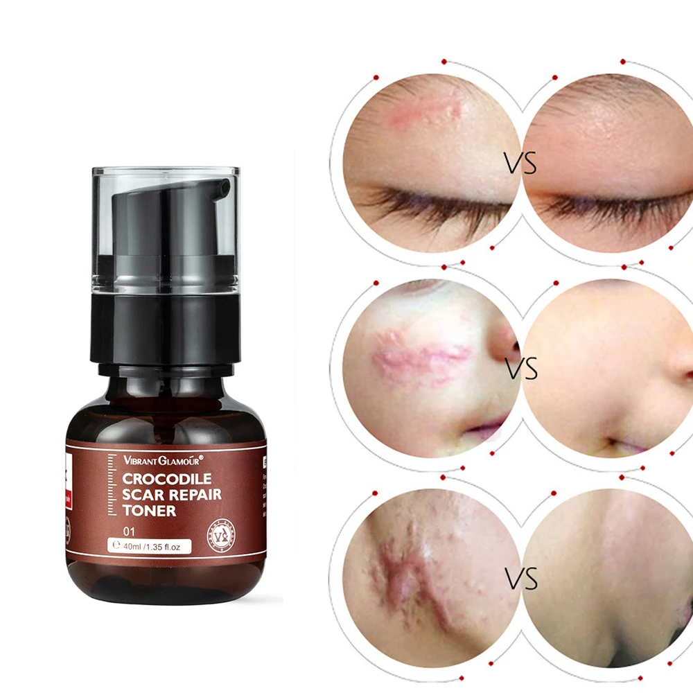 40ml Crocodile Scar Repair Serum Anti-inflammatory Area Prevent Hyperplasia Moisturizer Skin Care Acne | Красота и здоровье