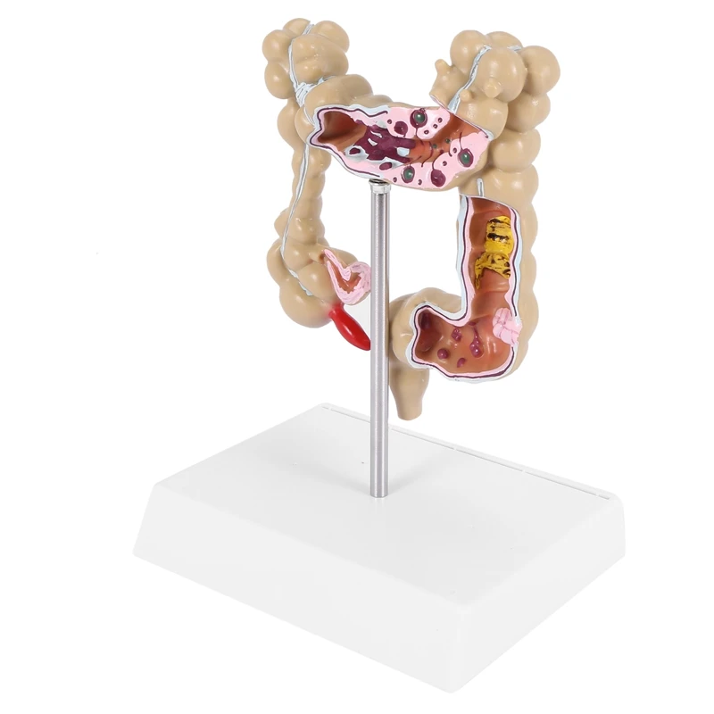 

Колоректальная искусственная человеческая Колона, модель патологических заболеваний большого кишечника, анатомия Mrganizer
