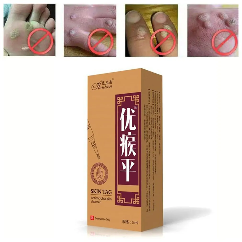 Средство для удаления бородавок папилломы Быстрое Удаление родинок