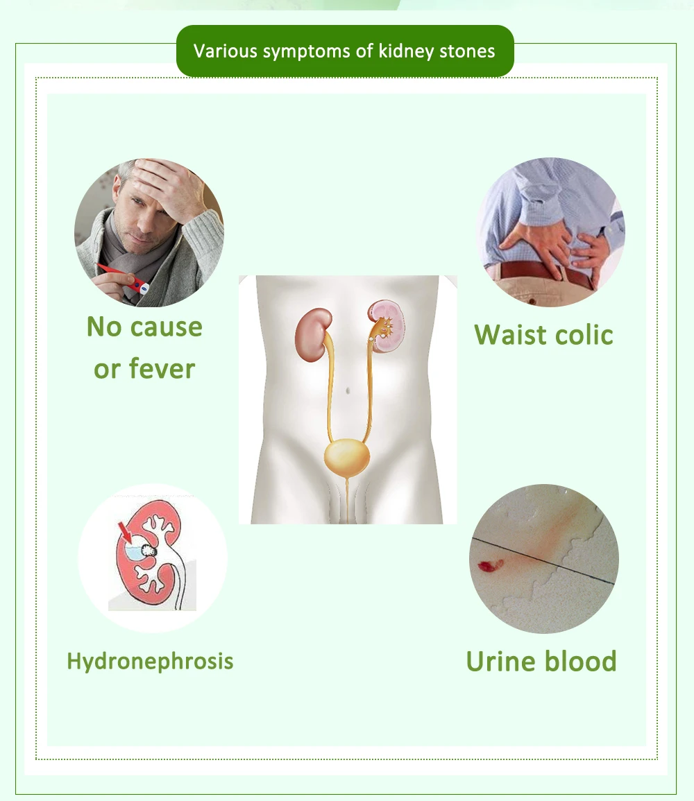 40 шт/2 упаковки камни в почках очищающий чай чистый токсин диуретический