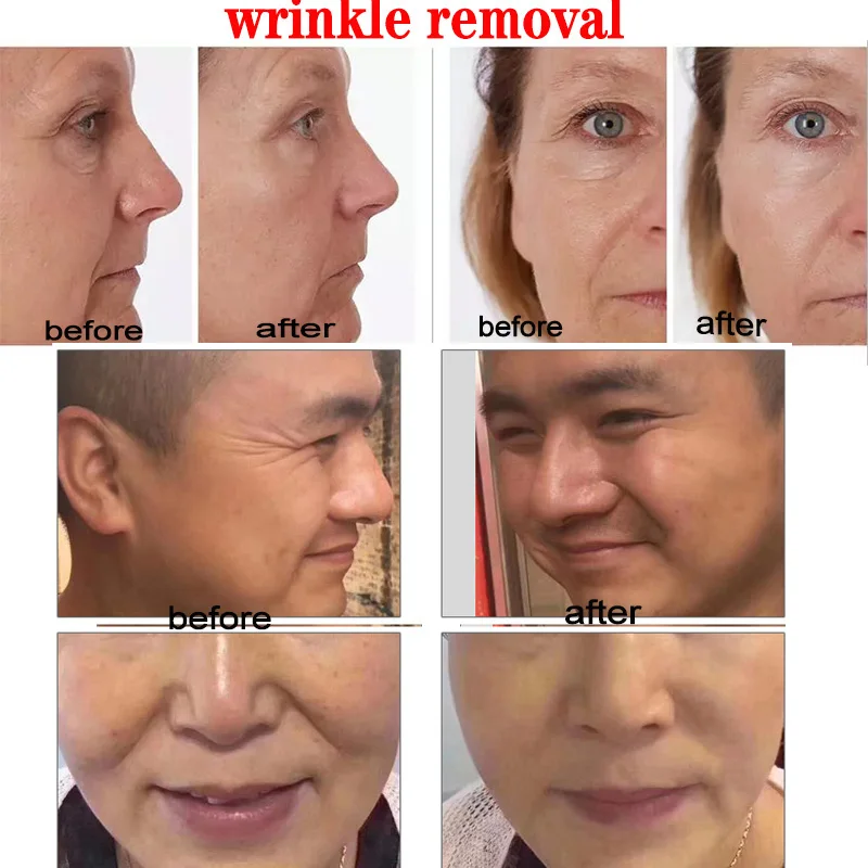 Гиалуроновая ручка с атомайзером гиалуроновой кислотой комплект для съемки