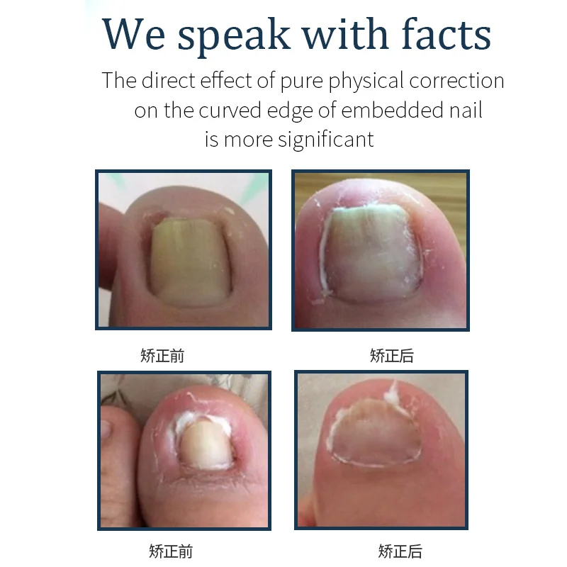 Orthodontic correction of nails and in the meat | Красота и здоровье