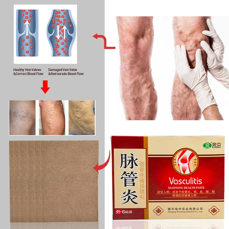 12 шт. = 2 коробки пластырь от варикозного расширения вен|Пластыри терапевтические|