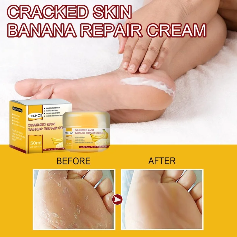 

Cracked Skin Banana Repair Cream Dry Skin Moisturizing Cream To Repair Chapped Banana Cream Callus Remover Gel for Feet