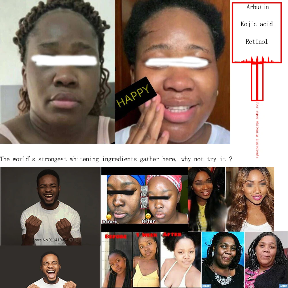 Отбеливание Сыворотки натуральный альфа арбутин по уходу за кожей постоянный