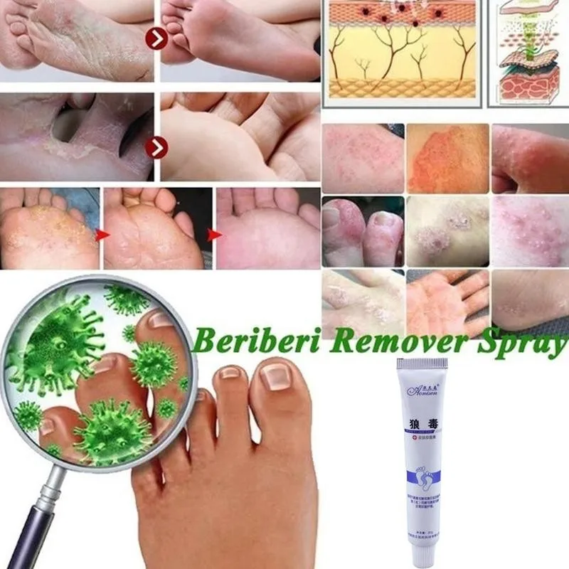 

Крем для ног, уход за ногами для спортсменов, пилинг для ног, зуд, эрозийный Beriberi