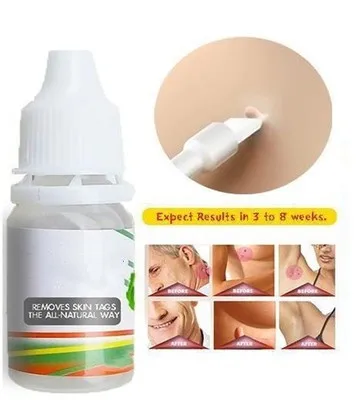 10 мл средство для удаления кожных тегов ног кукурузные бородавки лечение