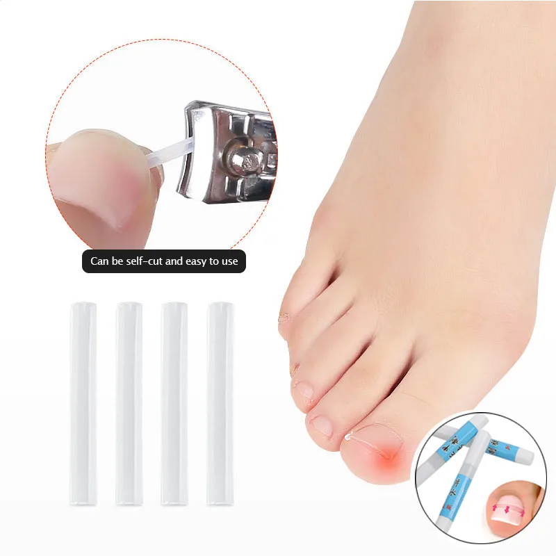 

Ingrown Toenails Corrector Tools Pedicure Recover Embed Toe Nail Treatment professional Ingrown nail Correction Foot Care Tool