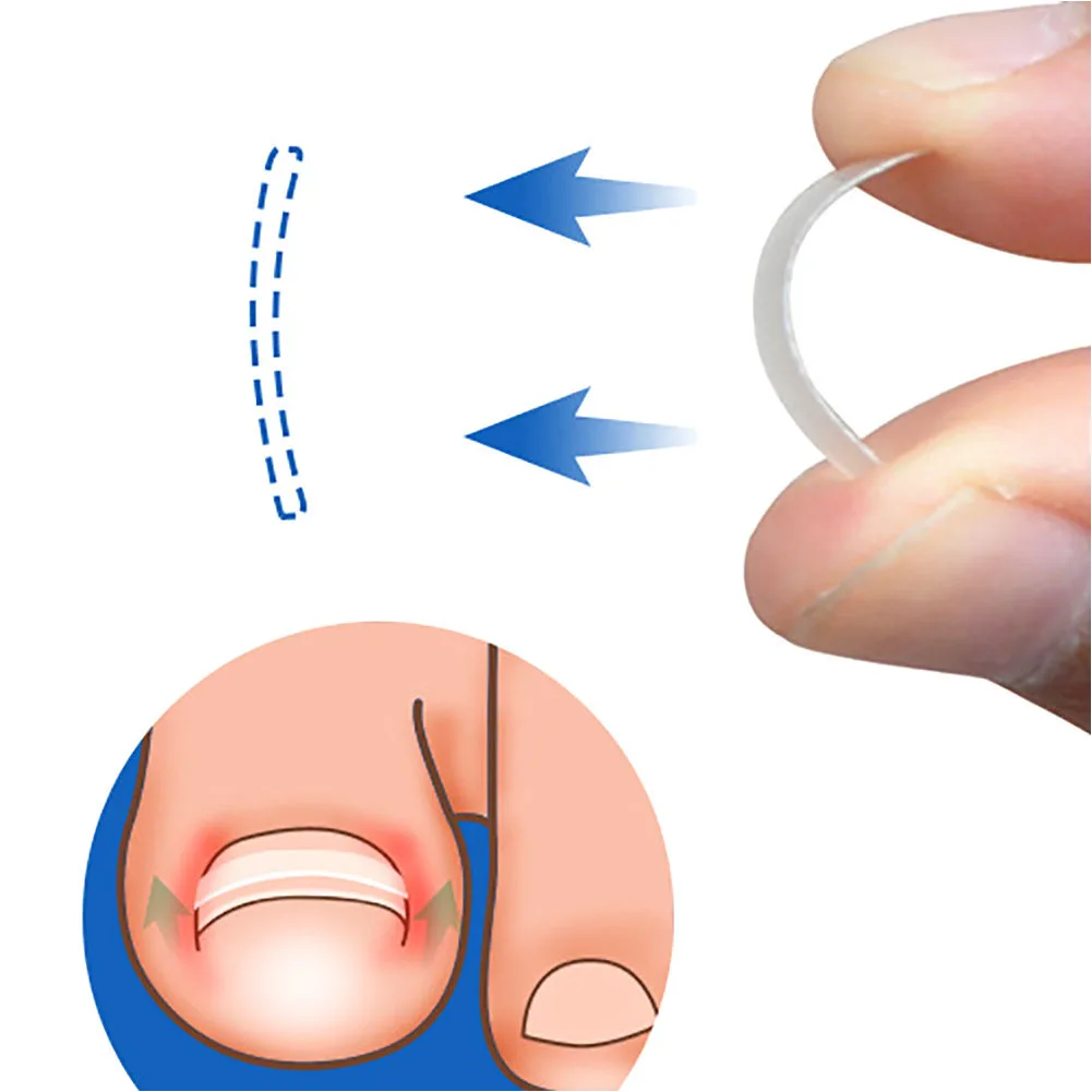 

Lifter Treatment Foot Care Repairing Protector Device Ingrown Embed Patch Brace Toenail Correction Tool Set Straightening Clip