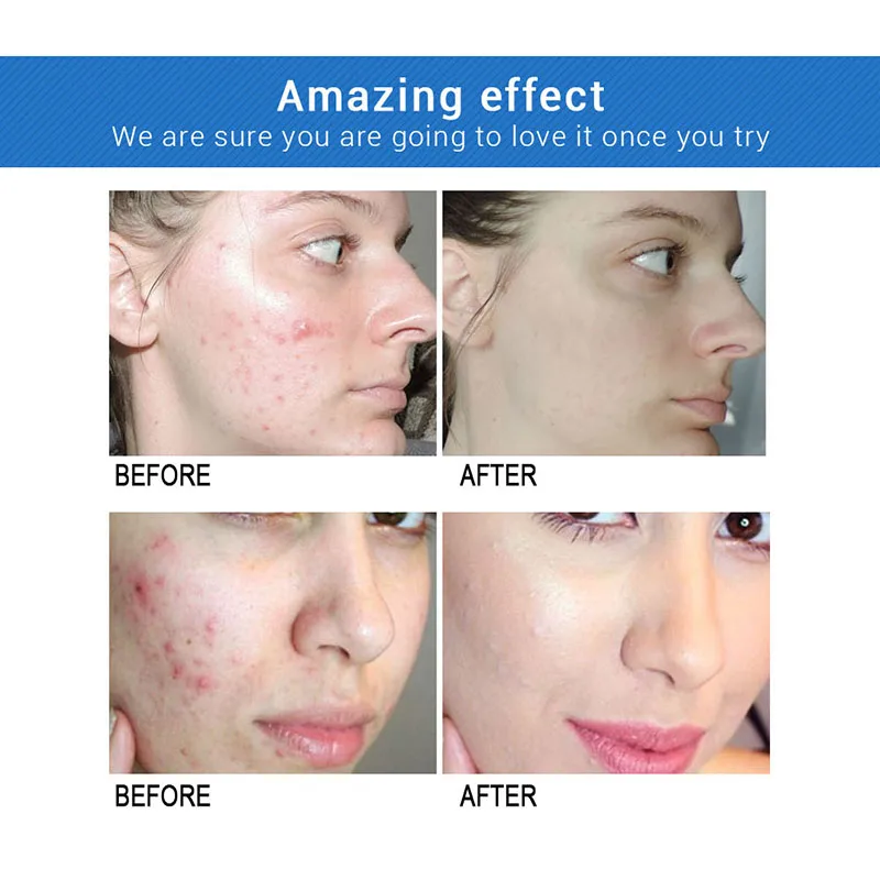 

Women Skin Care Series BIOAQUA 3 Sets Face Care Repair Acne Scar Cream Smooth White Acne Anti essence Skin Care Deep Clean