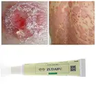 1 шт. псориаз для тела дерматит экзема зуд псориаза нейродерматита псориаза мазь Китай аллергический крем для кожи Proble S3U5
