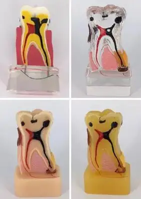 4X comprehensive pathological tooth model 4pcs sets 6*4*10cm Oral cavity model free shipping