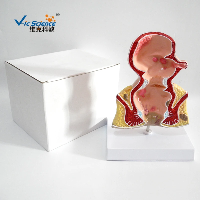 Education teaching PVC Rectum Pathological model