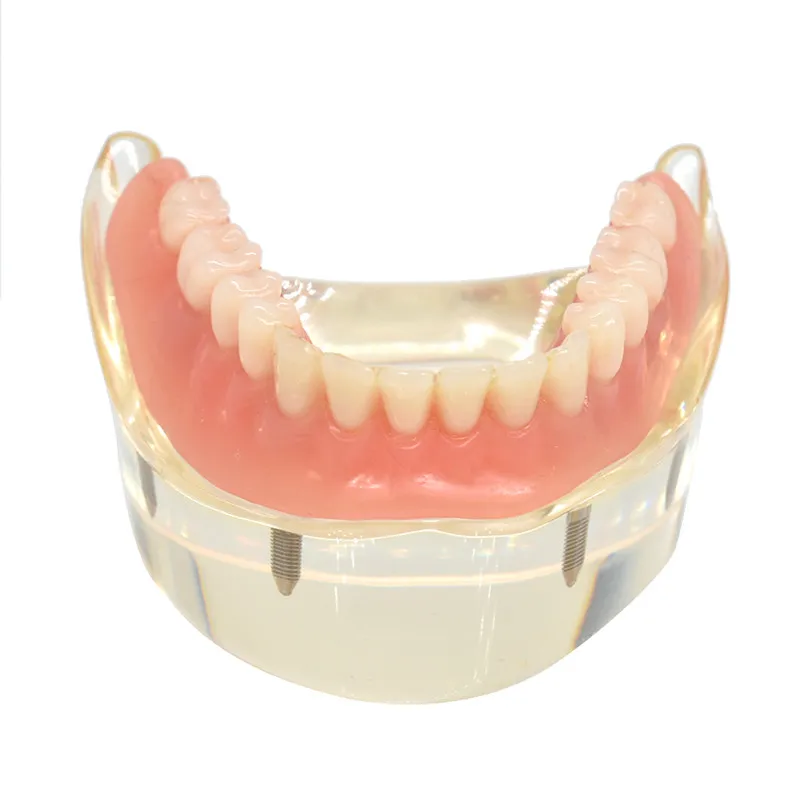 

Модель зубного протеза, съемная мандибулярная Нижняя модель зубов с 4 винтами для имплантации, модель для реставрации имплантов, обучающая ...