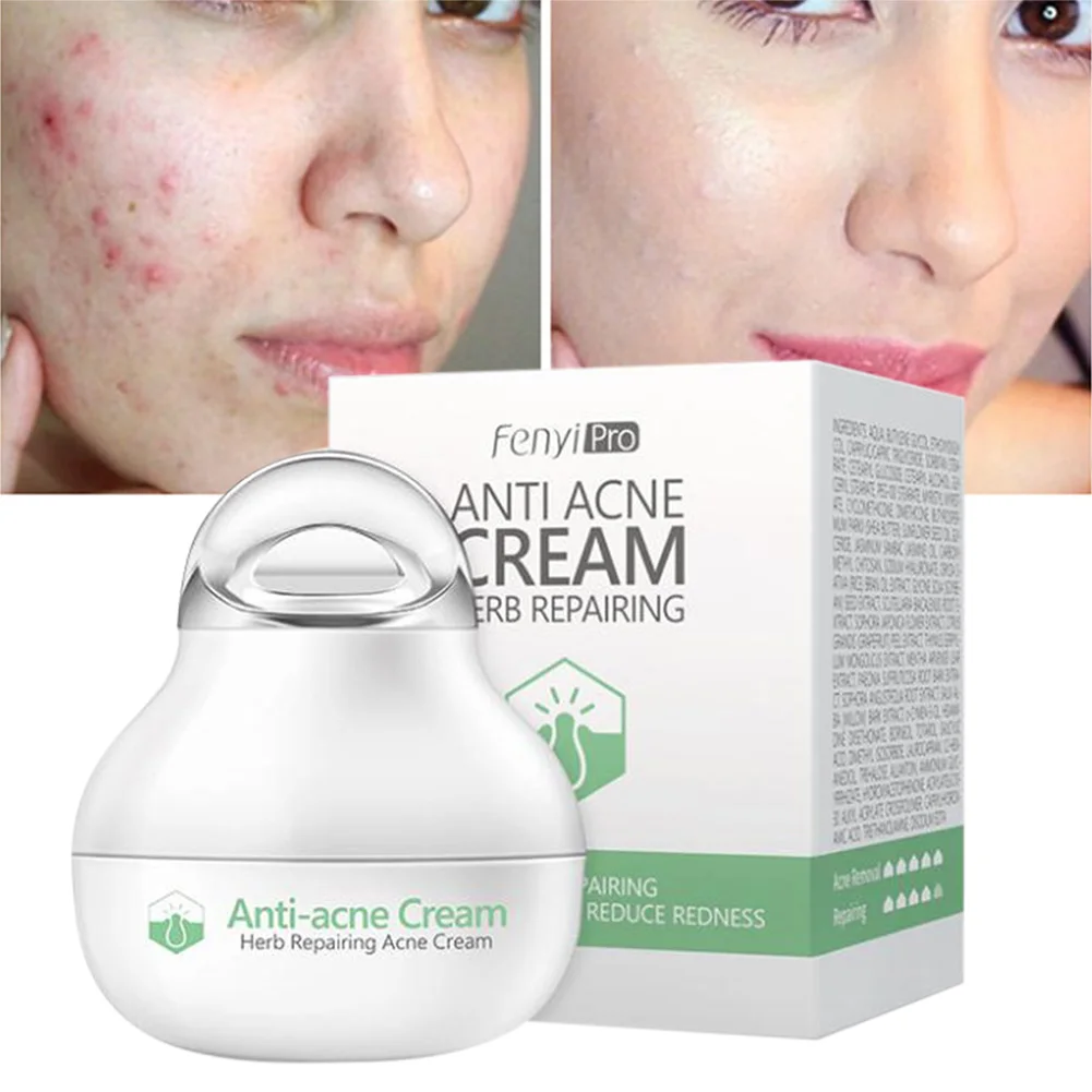 

Effective anti-acne cream acne treatment fade acne spots oil control shrink pores whitening moisturizing acne cream skin care