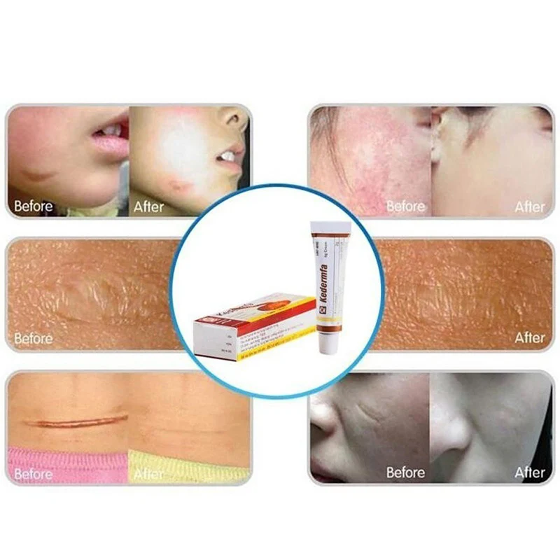 

High Quality Youthful Scar Rejuvenating Burn Scar Removal Cream Vietnam Snake Oil Skin Care Cream