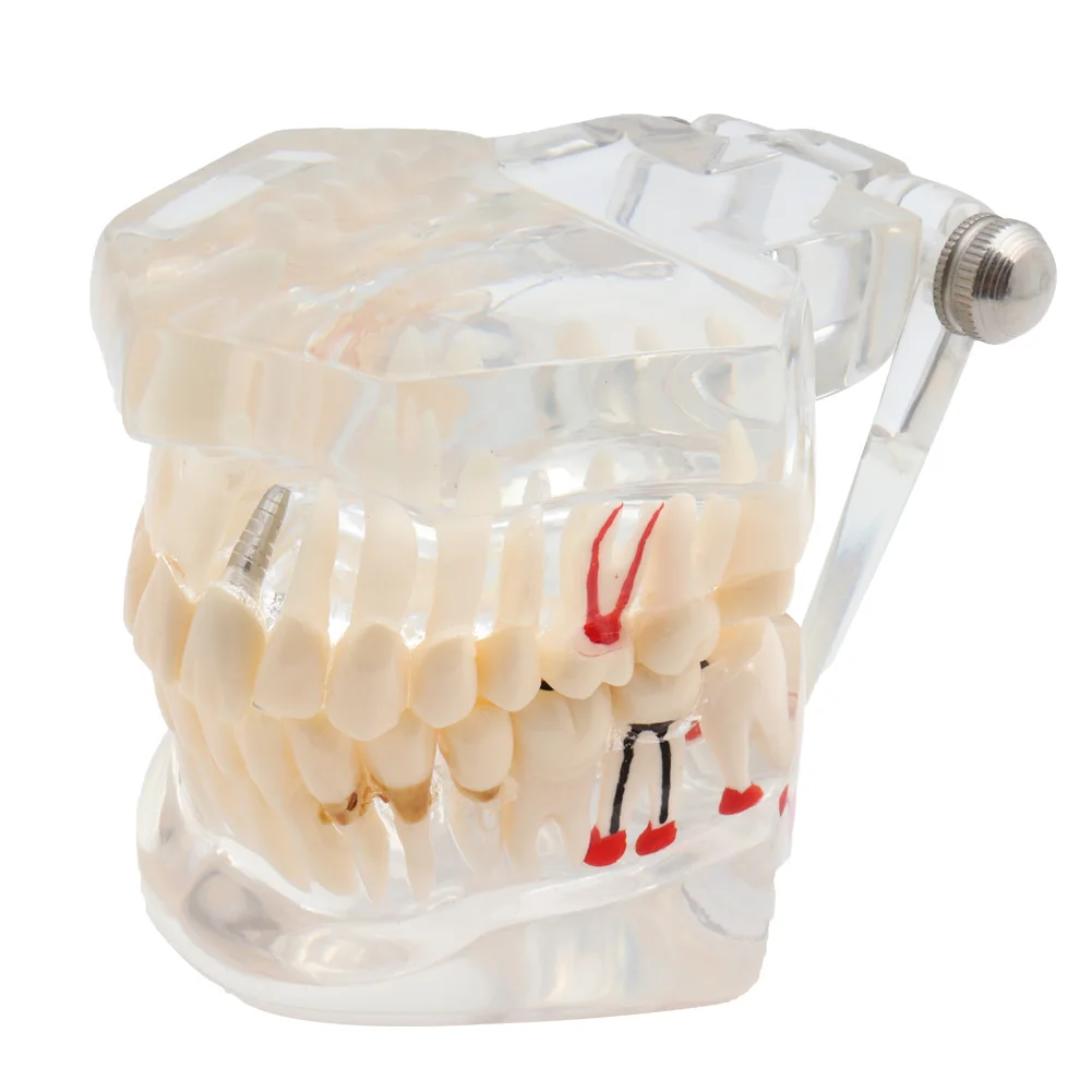 Зубная модель зубов имплантат и реставрация прозрачное исследование