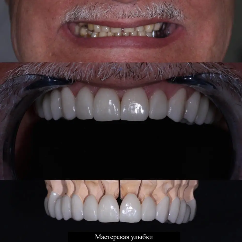 5 шт. C14/B40 LT/HT BL отбеливатель цвет стоматологический литиевый дисликат блок для CEREC