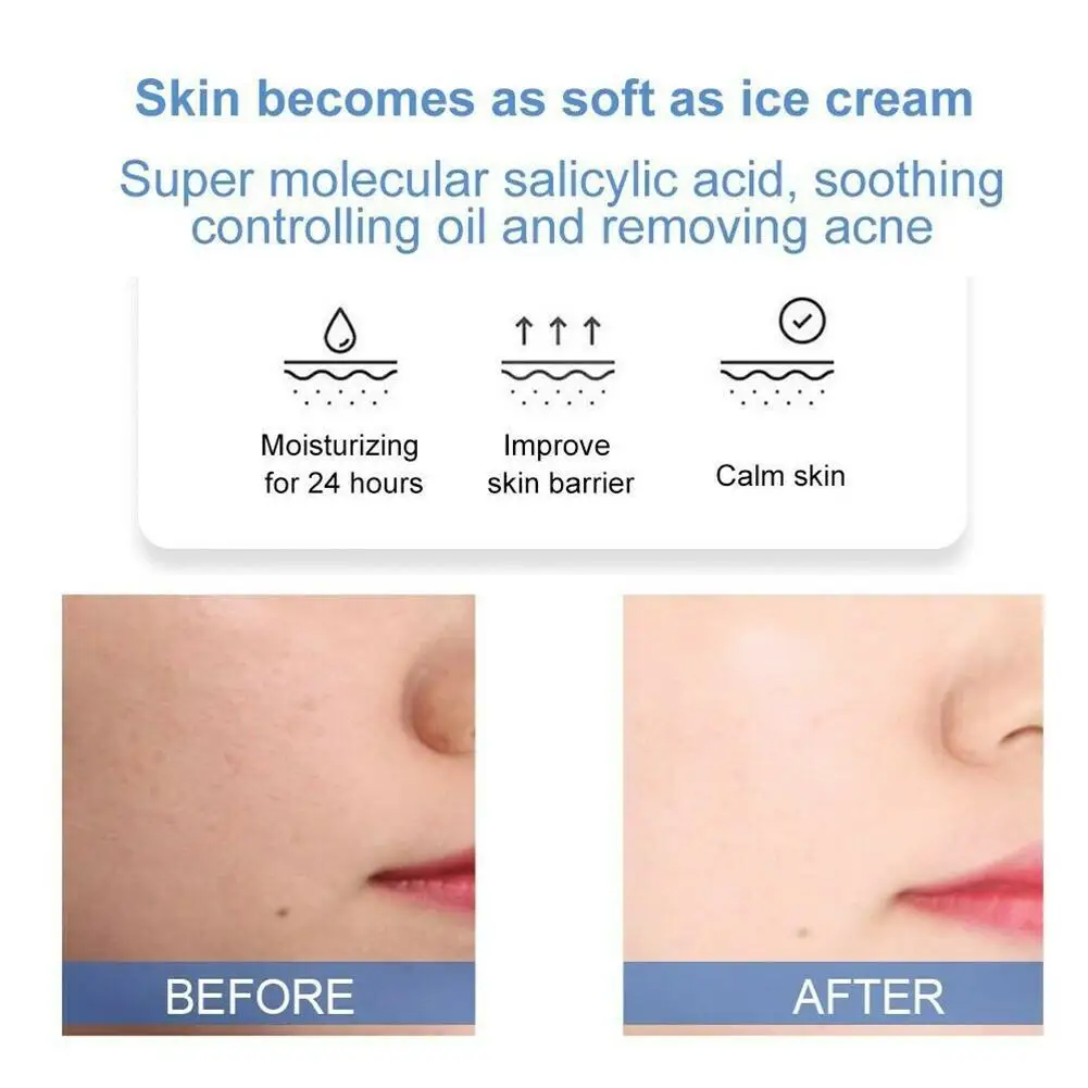 Салициловая кислота мороженое маска с автоматической фокусировкой для того