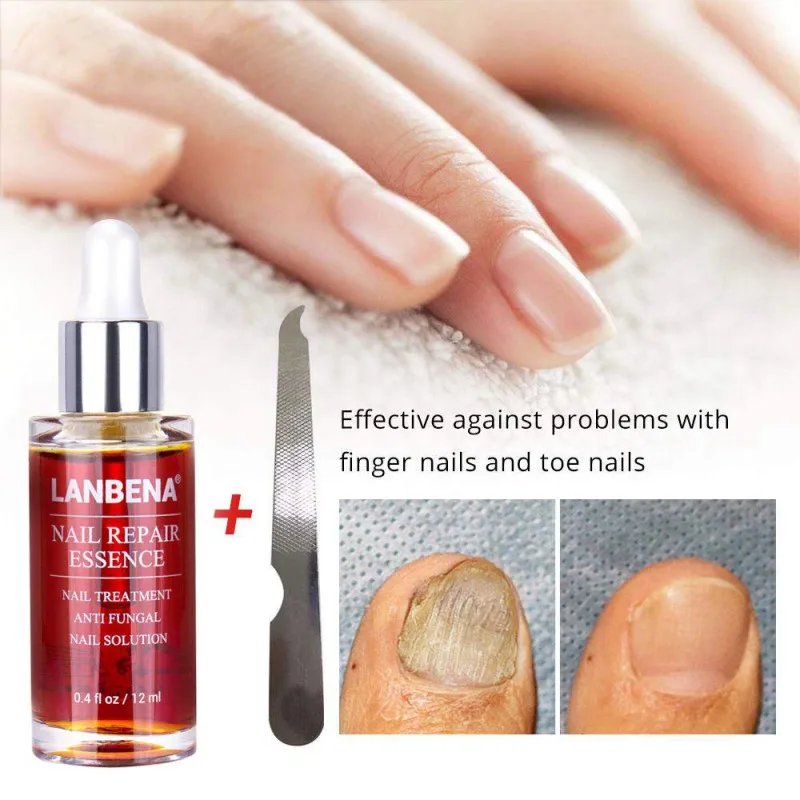 Грибковое Лечение ногтей мощное удаление грибка анти-инфекция Paronychia Onychomycosis