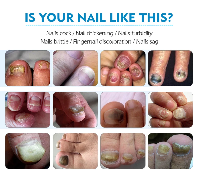 Яркие Гламурные 20g гвоздь ToeRepair крем Лечение грибка ногтей онихомикоз удаления