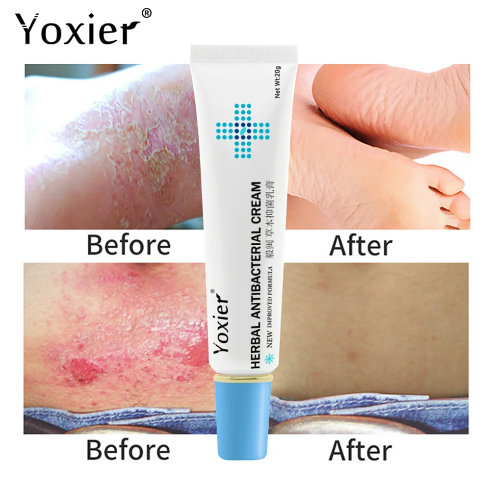 

Relieve Itching Herbal Eczema Psoriasis Cream Antibacterial Dermatitis Athletes Foot Irritation Allergies Lithospermum Skin Care