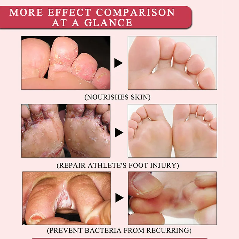 

Bunions Effective Foot Cream Treatment Anti Fungal Infection Onychomycosis Paronychia Toe Fungus Gel Repair Dry Crack Feet Care